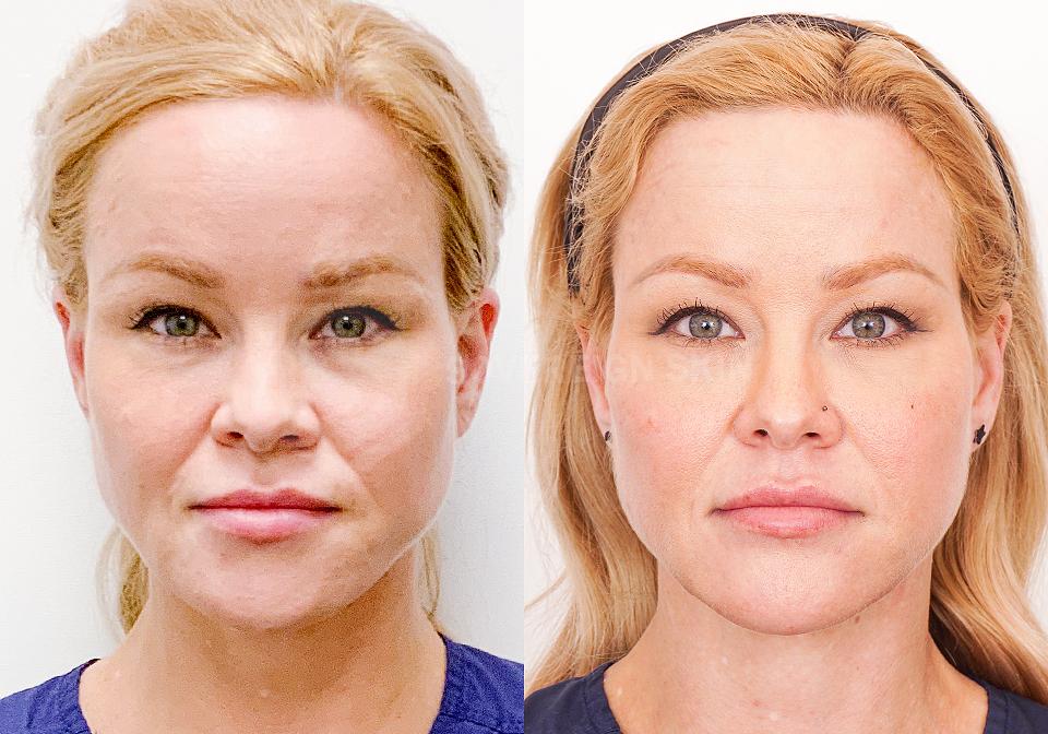 InstaLift® Thread Lift Toronto | Non-Surgical Face Lift