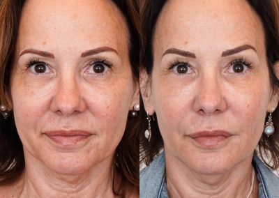 Ultherapy Before After P2 2
