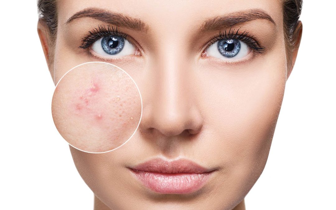 Get Rid of Acne at Sovereign Skin Laser Clinic in Toronto