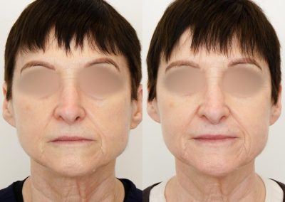 Ultherapy Before After P3 2
