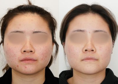 Laser Acne Before After P4 2
