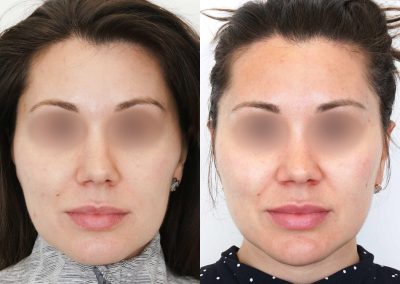 Ultherapy Before After P5 (1)