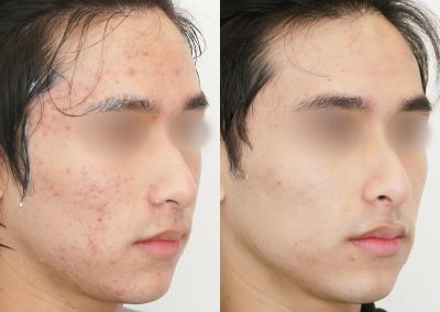 Laser Acne Before After P6 (1)