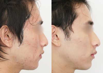 Laser Acne Before After P6 (2)