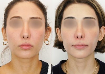 Ultherapy Before After P6 (1)
