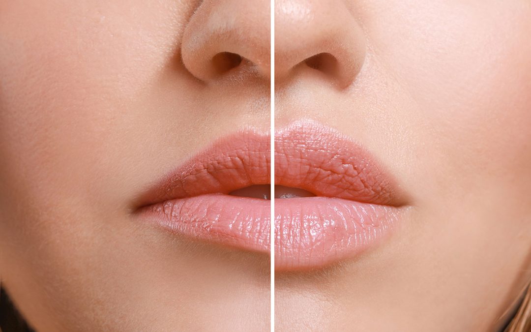 Want Fuller Lips Without Worry? Let’s Talk Natural-Looking Lip Fillers