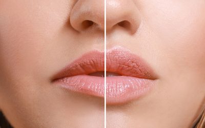 Want Fuller Lips Without Worry? Let’s Talk Natural-Looking Lip Fillers