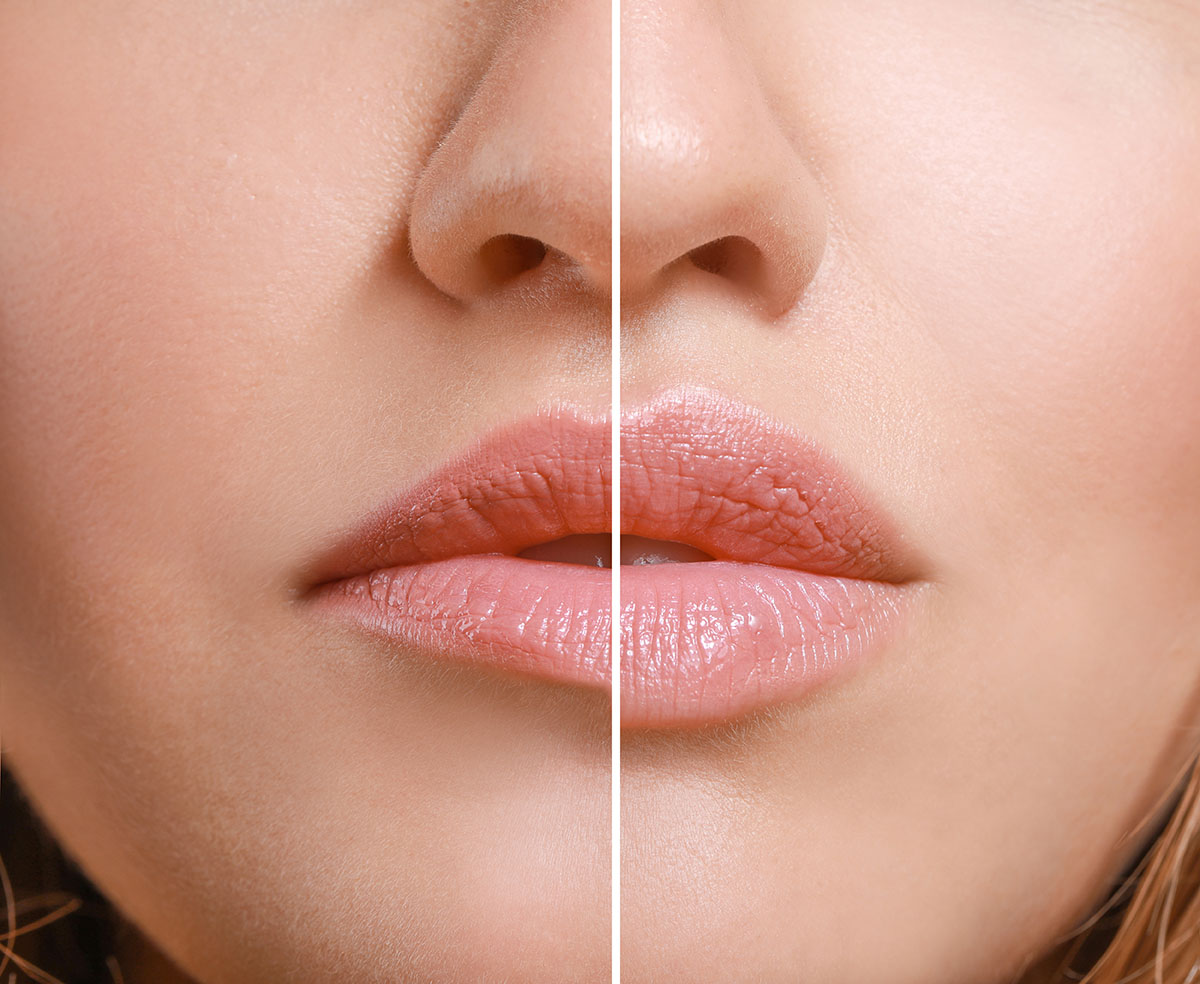 Lip Fillers For Fuller Lips