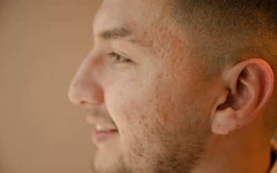 Choosing Acne Scar Laser in Toronto Without Damaging Summer Skin