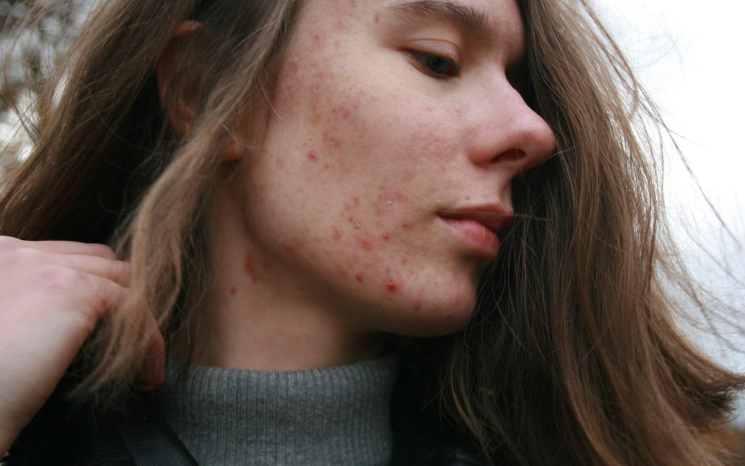 Acne Scar Types: Best Non-Laser Options in Toronto and Expected Results