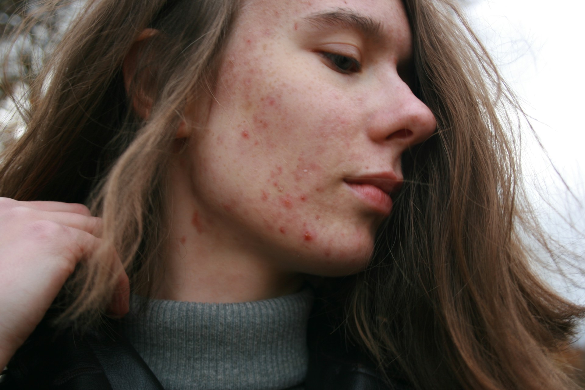 acne scar