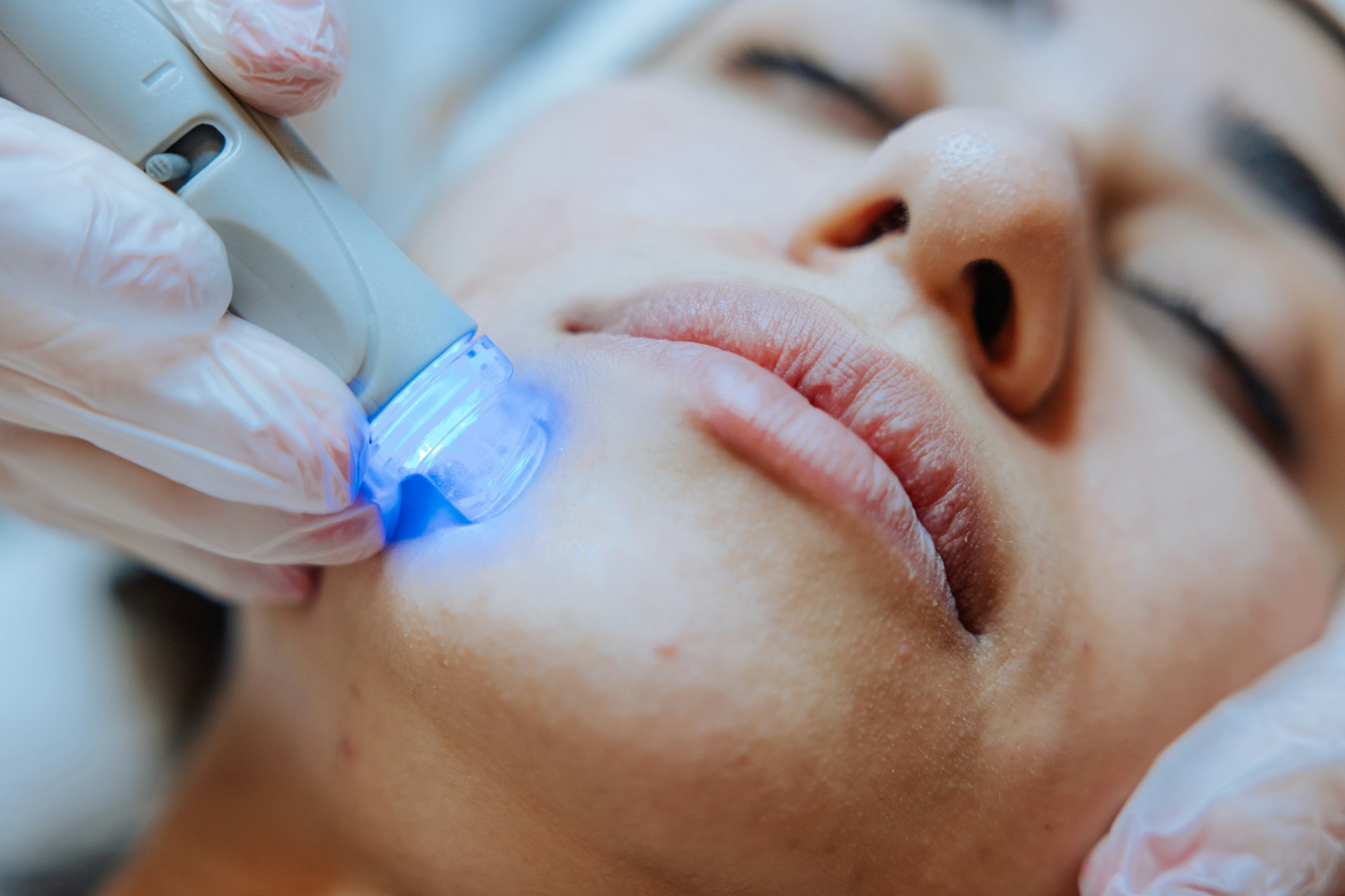 Laser Skin Resurfacing Laser Skin Resurfacing