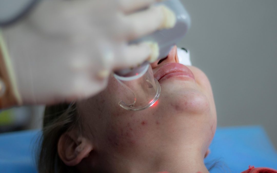 Managing Acne Scar Treatment in Toronto During Patio Season