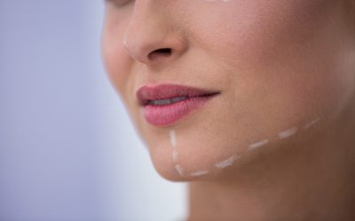 Questioning Thread Lift in Toronto for Early Jowls