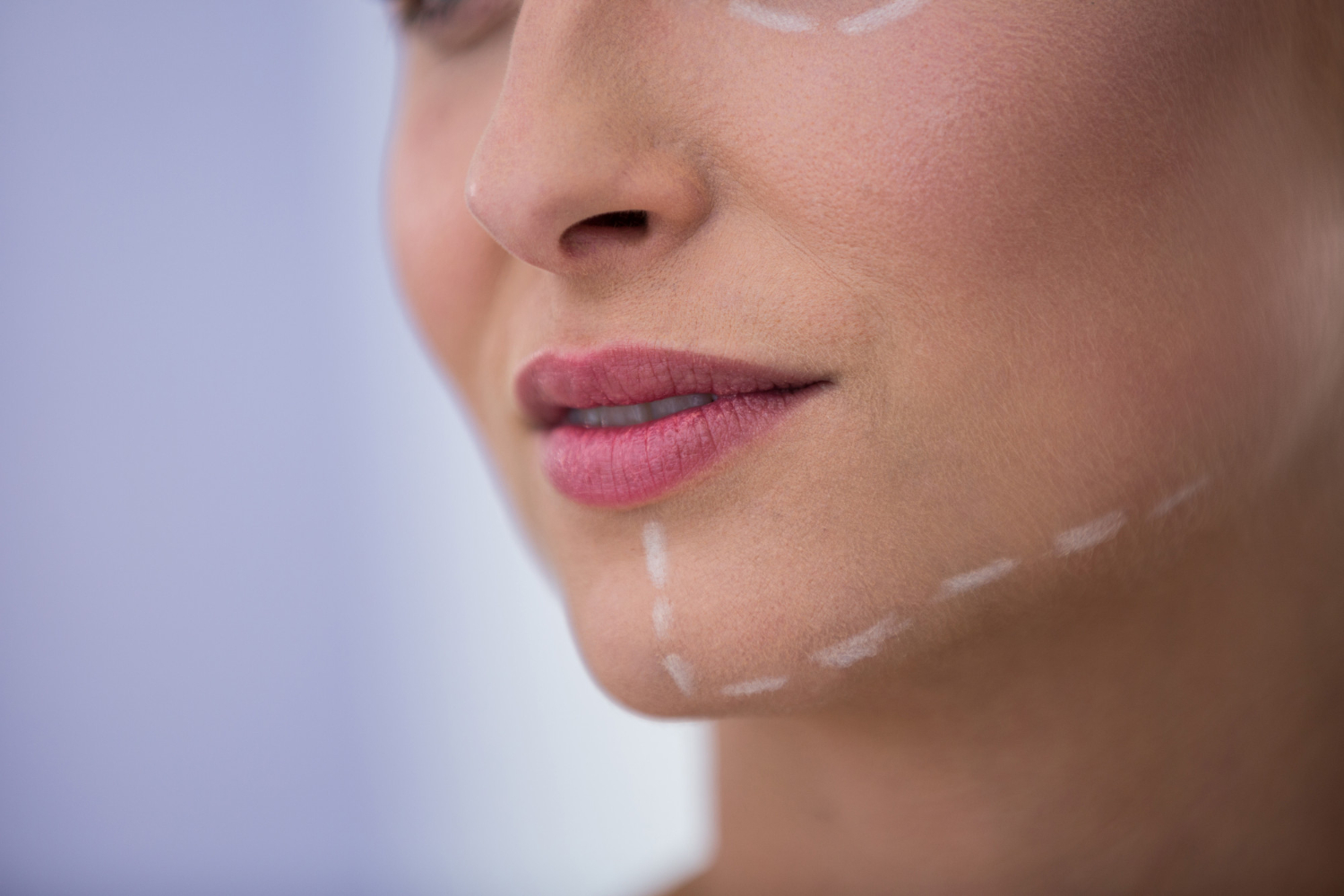 thread lift jowls