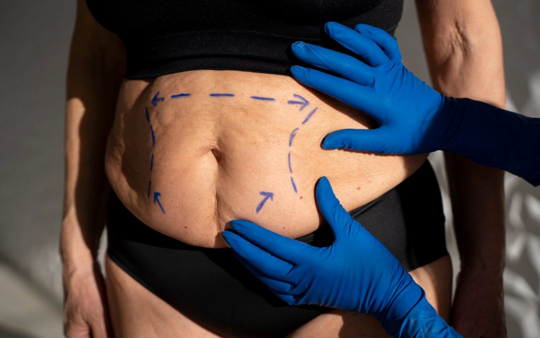 Preparing for a Toronto Tummy Tuck When You Live an Active Lifestyle