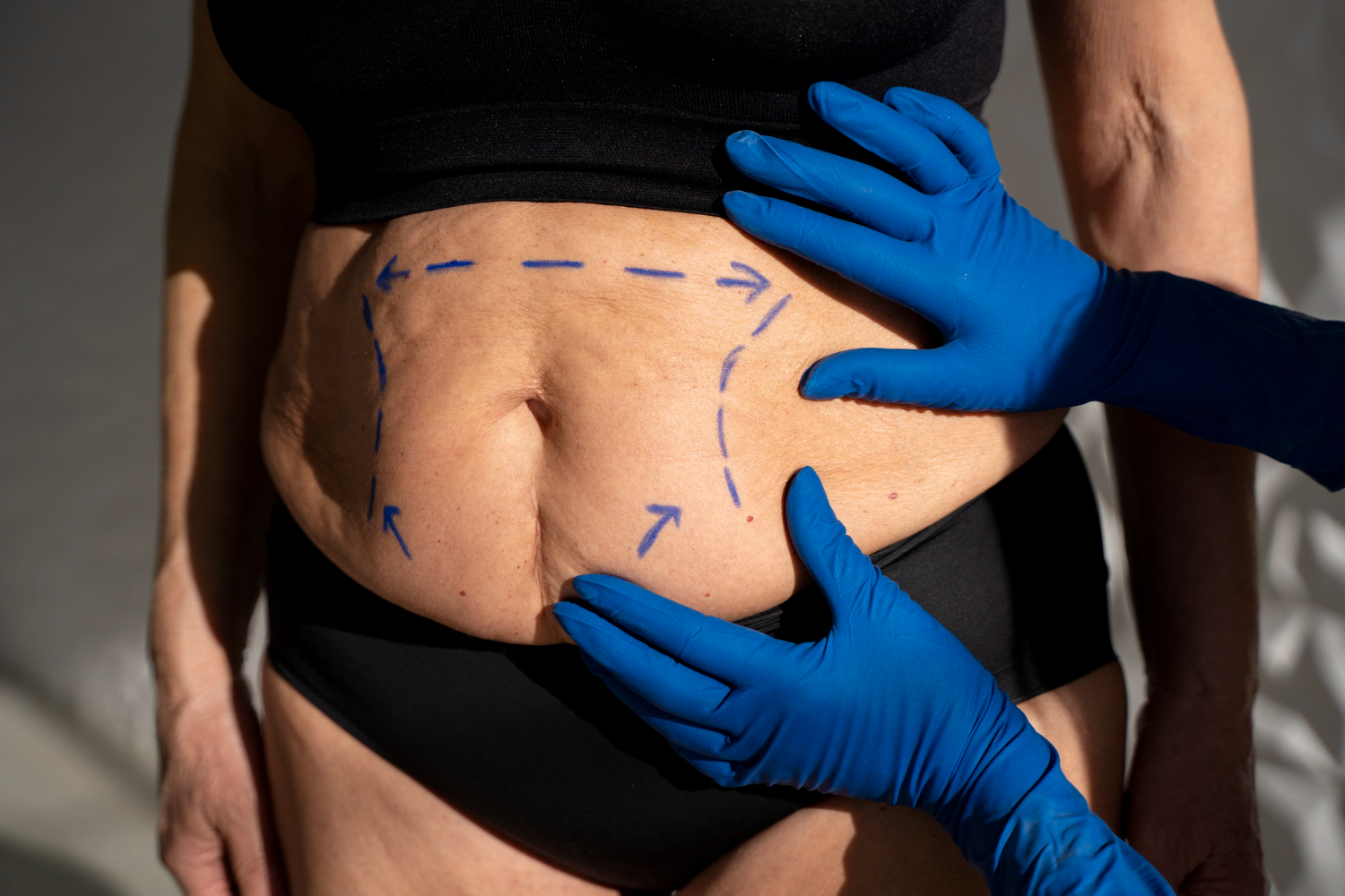 tummy tuck preparation