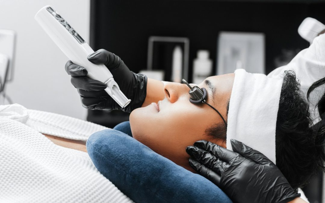 Laser Not Enough for Acne Scars in Toronto? Try Subcision, TCA CROSS, or Fillers
