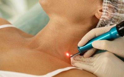 Early Signs You May Need Laser Scar Treatment in Toronto