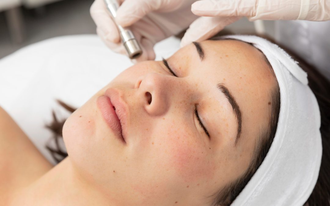 Post-Laser Pigmentation Prevention in Toronto: PIH Risk and 6-Week Protocol