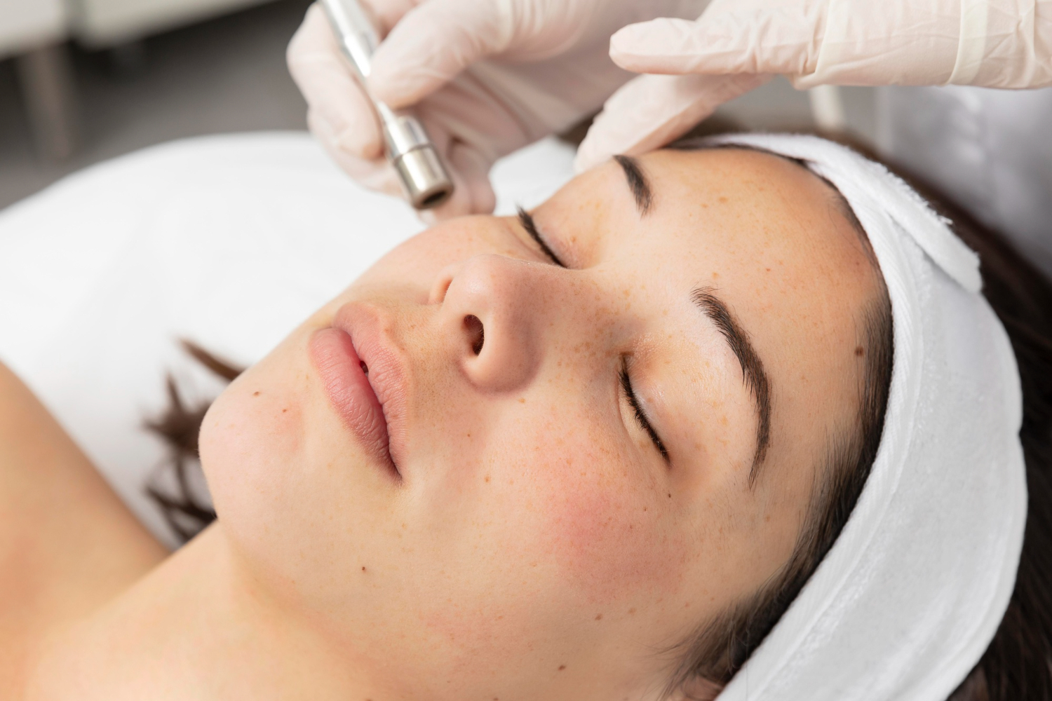 post laser pigmentation