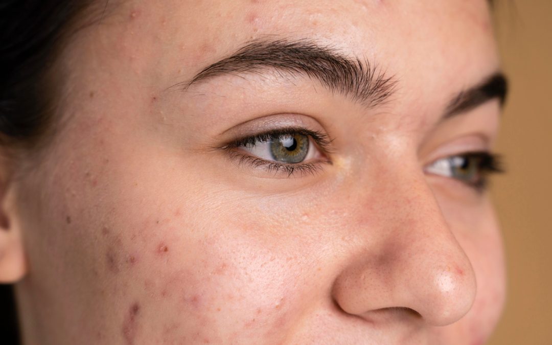 Recognizing When Acne Scars Need Professional Treatment in Toronto