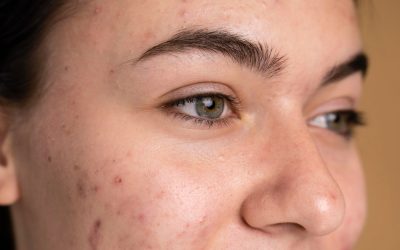 Recognizing When Acne Scars Need Professional Treatment in Toronto