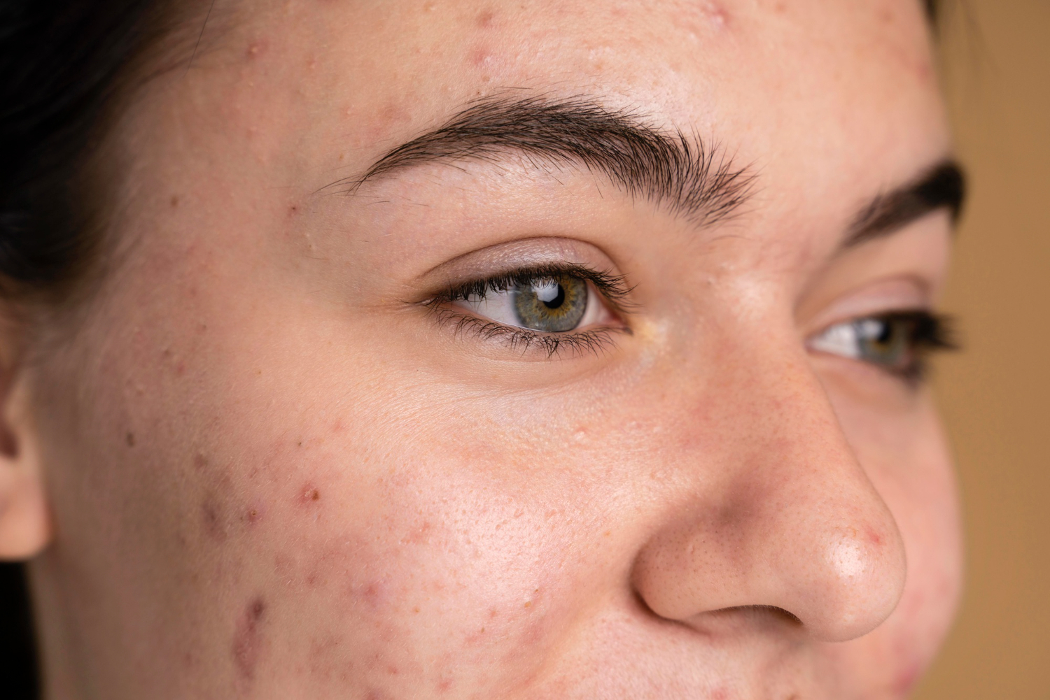 acne scars