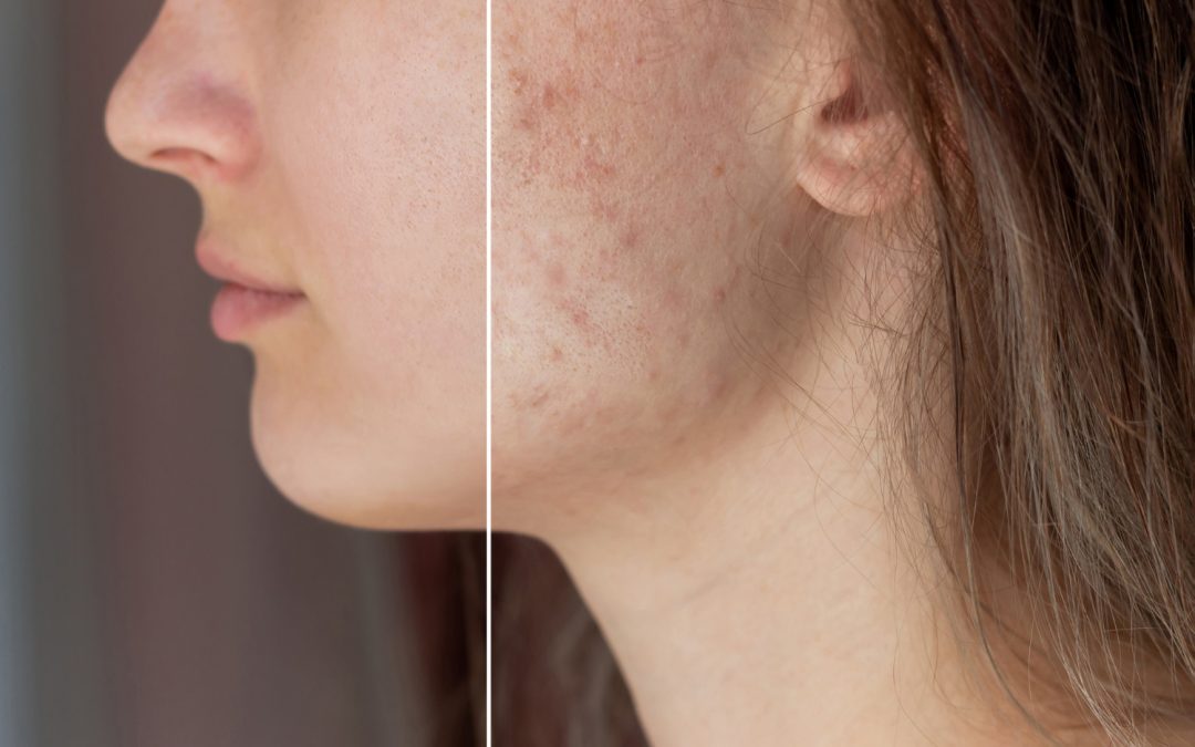 Is Acne Scar Laser in Toronto Safe for Active Breakouts?
