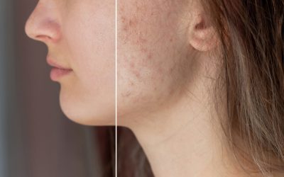 Is Acne Scar Laser in Toronto Safe for Active Breakouts?