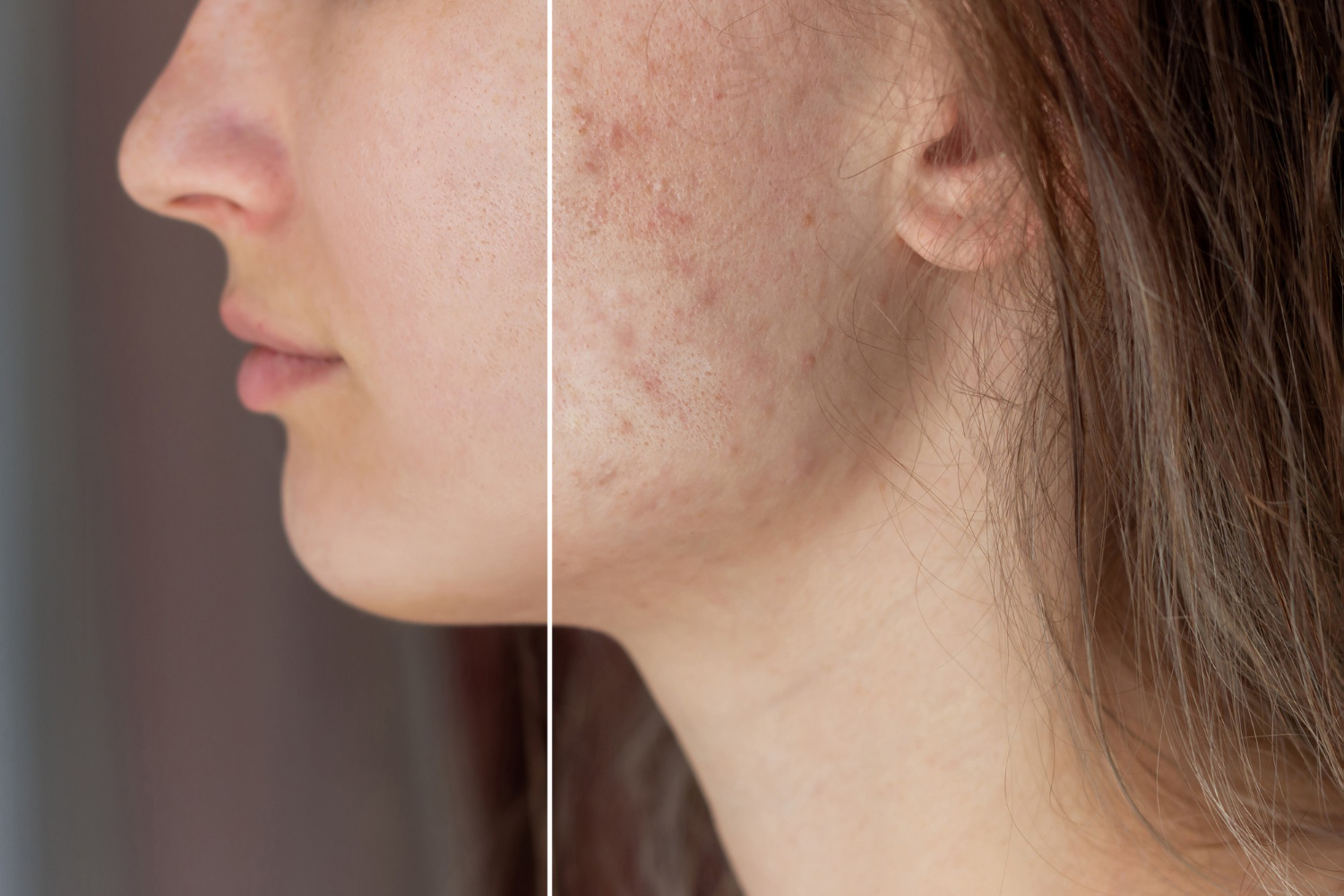 acne scars acne scars