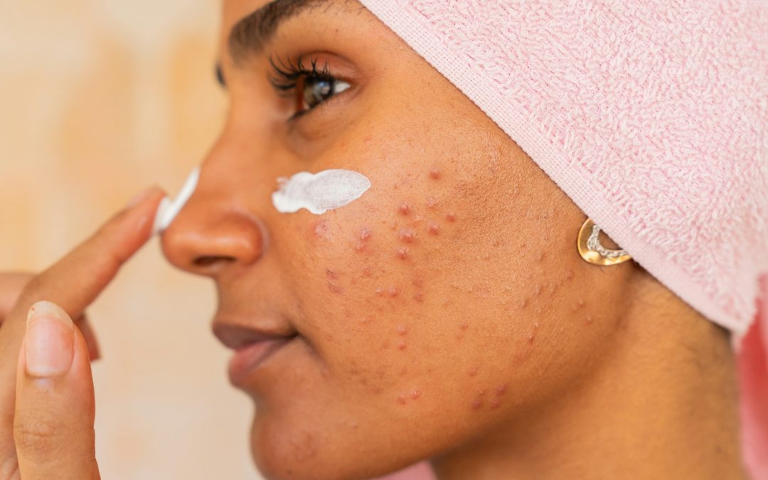 Humidity-Proof Acne Scar Aftercare in Toronto: Sweat and Infection Prevention