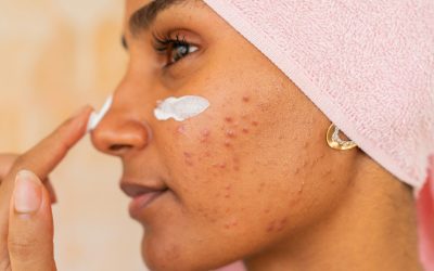 Humidity-Proof Acne Scar Aftercare in Toronto: Sweat and Infection Prevention