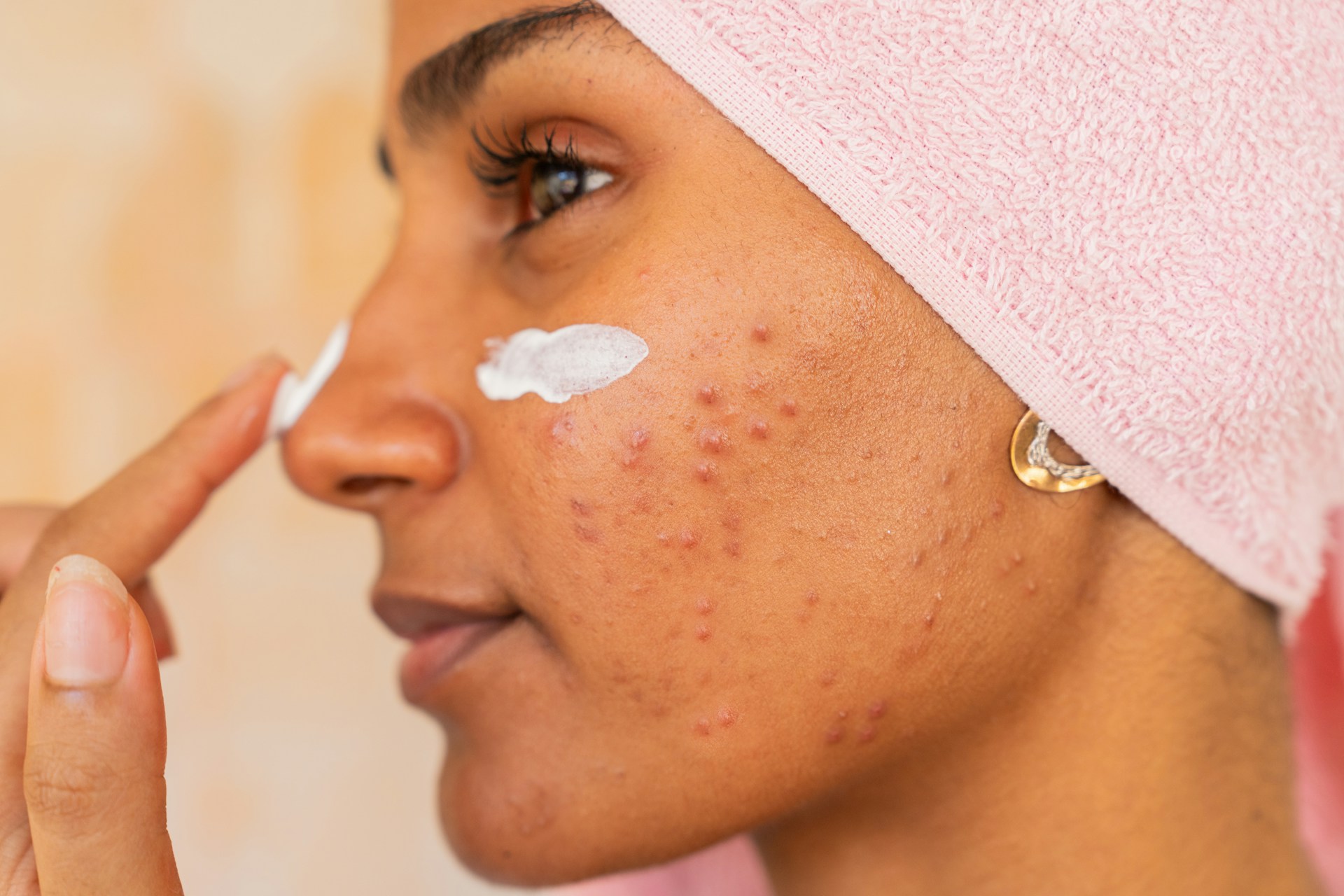 acne scar aftercare