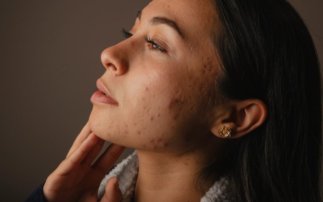 Pre-Laser Acne Scar Prep in Toronto: Skincare, Meds to Pause, PIH Risk