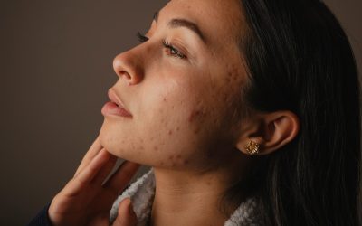 Pre-Laser Acne Scar Prep in Toronto: Skincare, Meds to Pause, PIH Risk