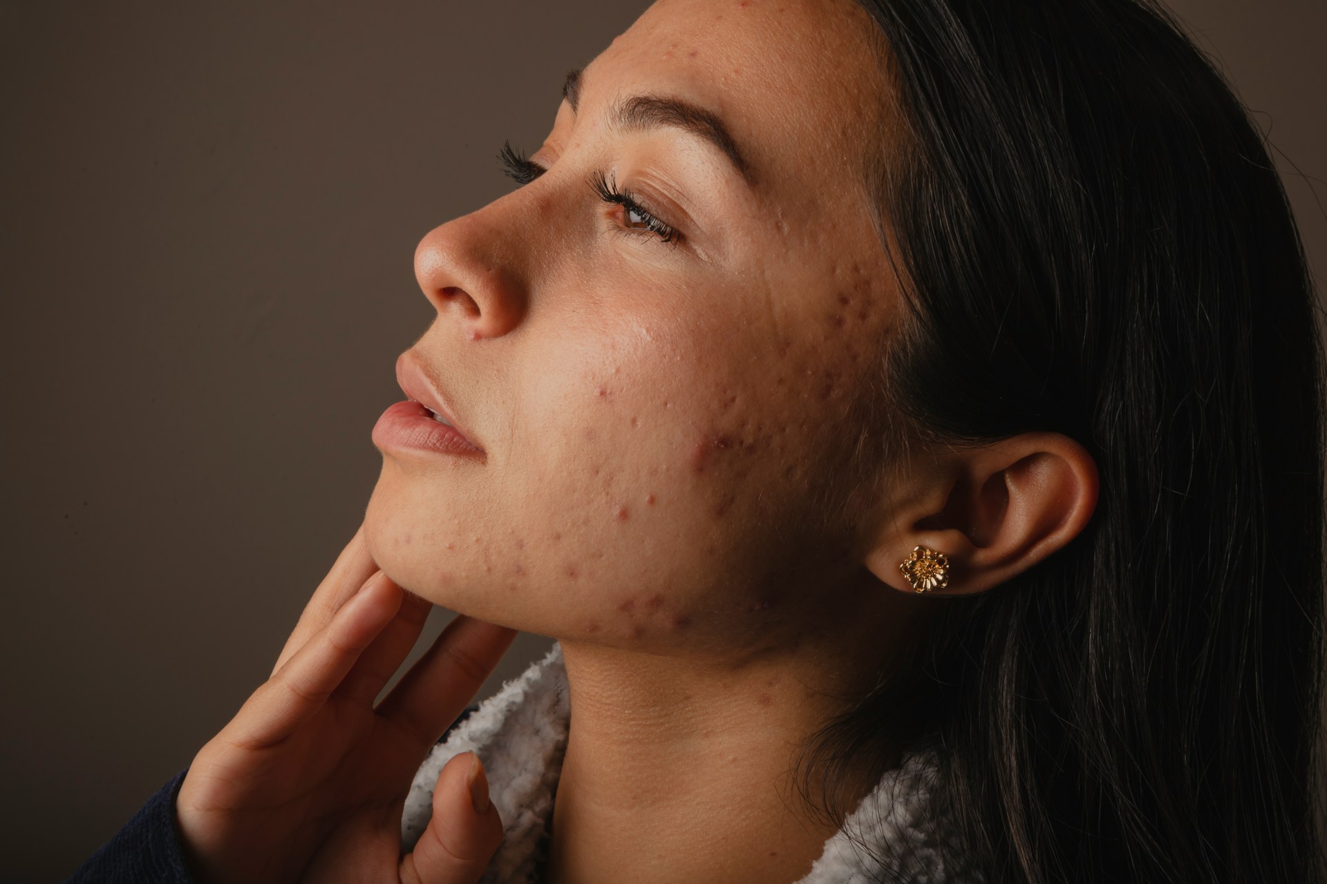 pre aser acne scar