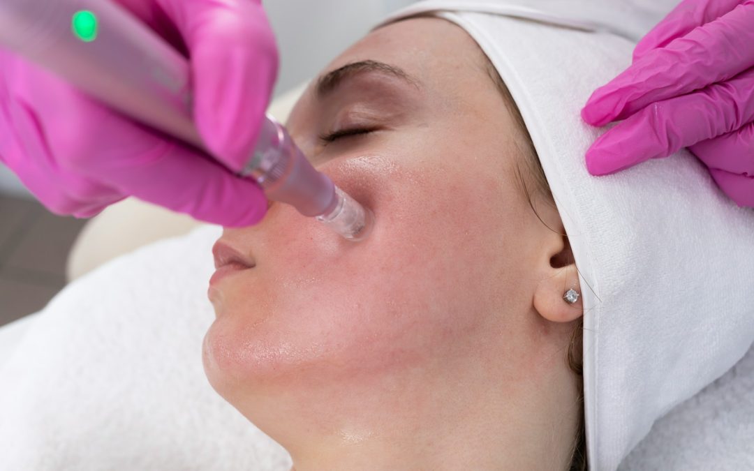 Early Acne Scar Treatment in Toronto Before Scars Set