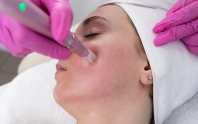 Early Acne Scar Treatment in Toronto Before Scars Set
