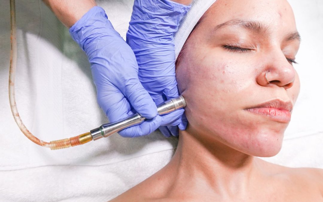 Post-Acne Skin Rejuvenation in Toronto with Chemical Peels