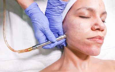 Post-Acne Skin Rejuvenation in Toronto with Chemical Peels