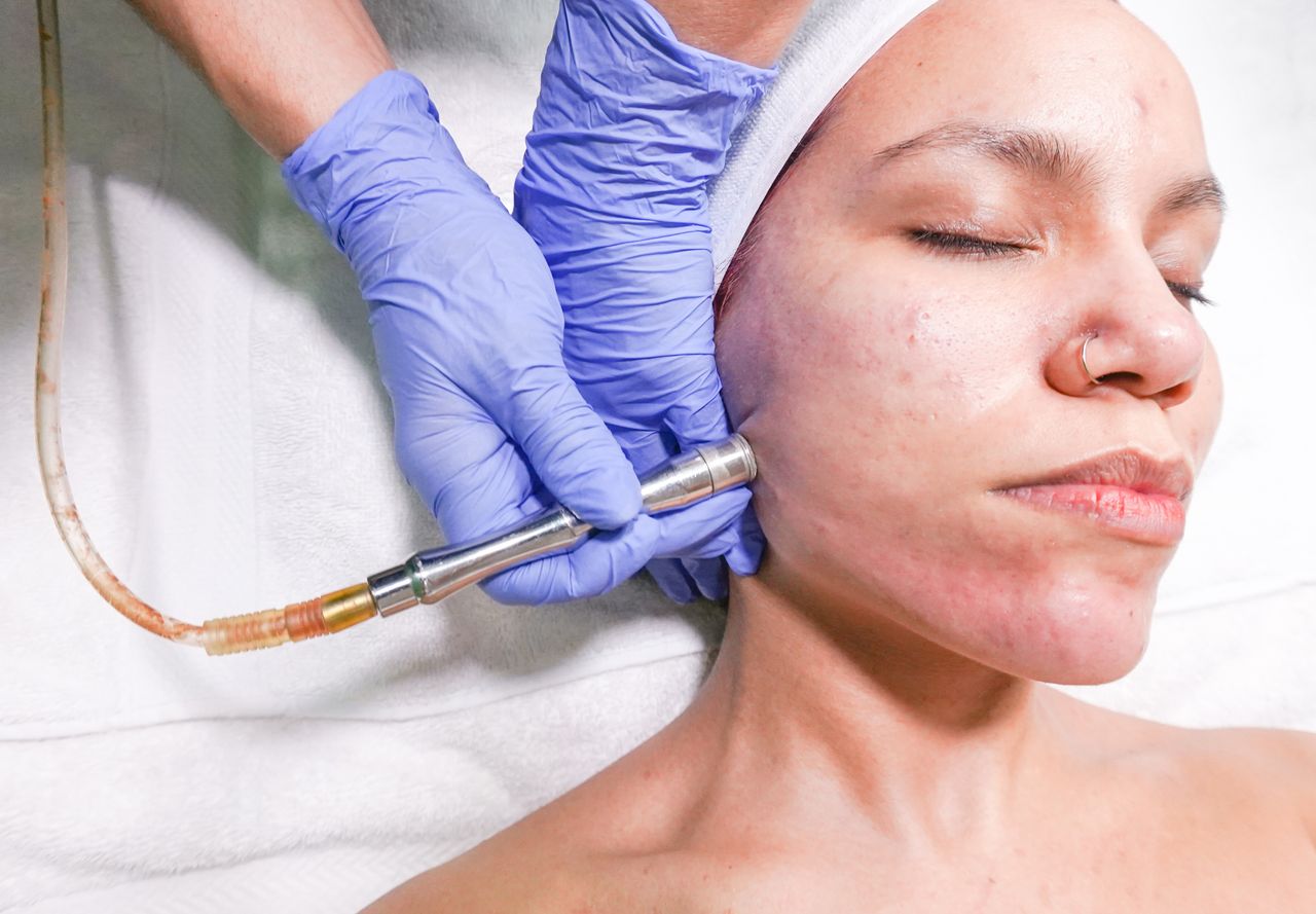 Post-Acne Skin Rejuvenation Post-Acne Skin Rejuvenation