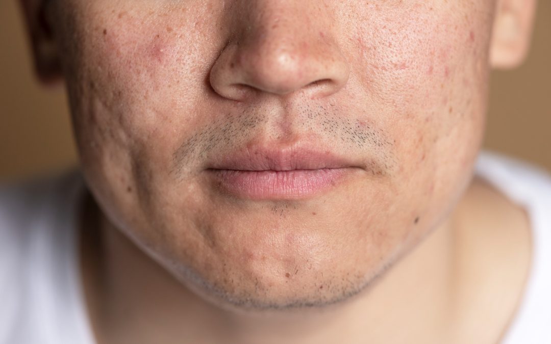 Assessing Acne Scar Treatment in Toronto for Late Summer Sun
