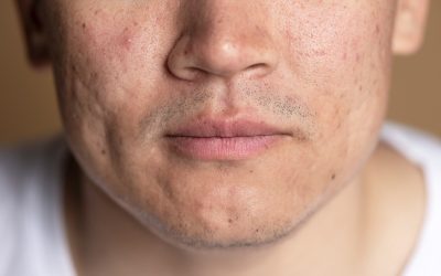 Assessing Acne Scar Treatment in Toronto for Late Summer Sun