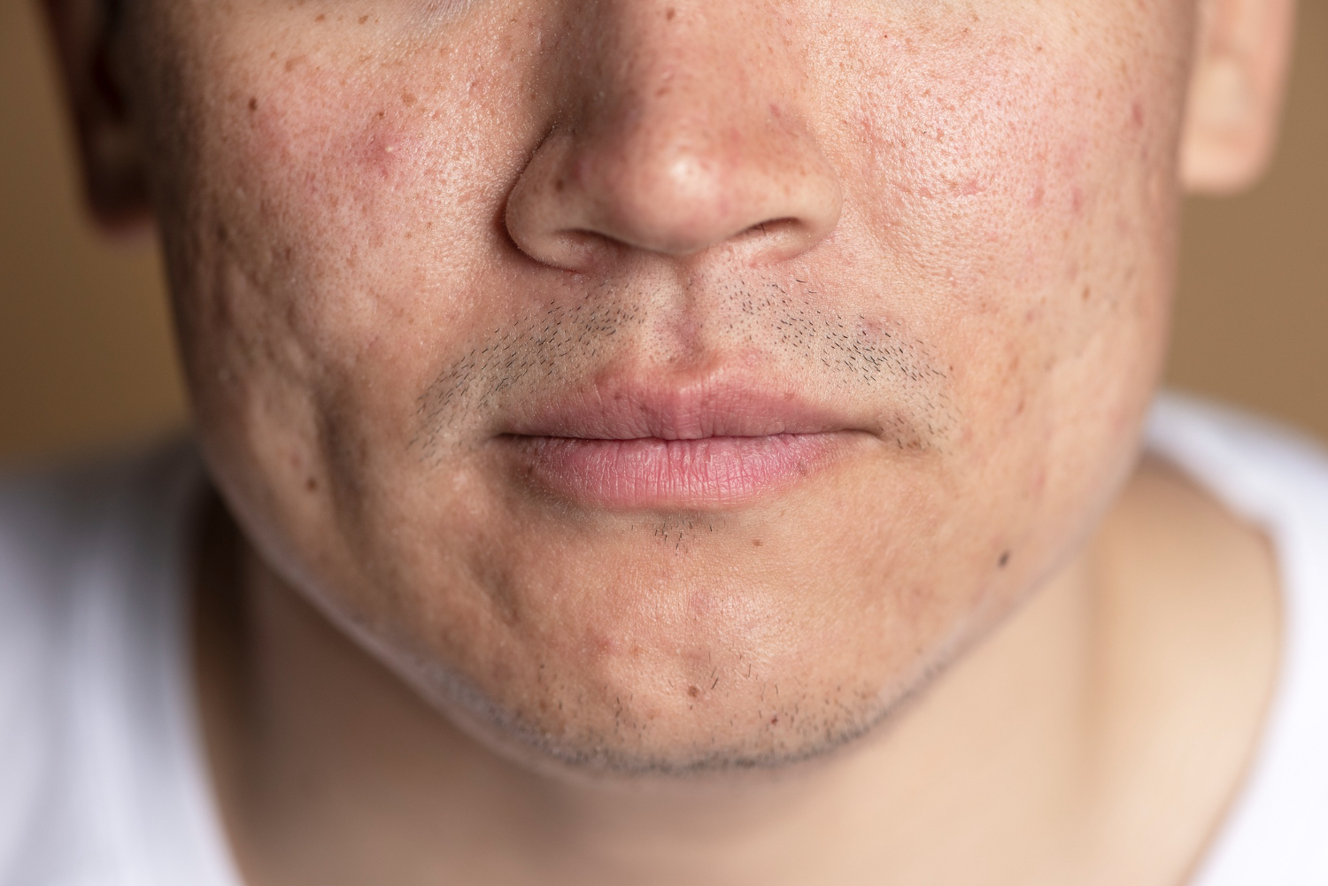 man with acne scars man with acne scars