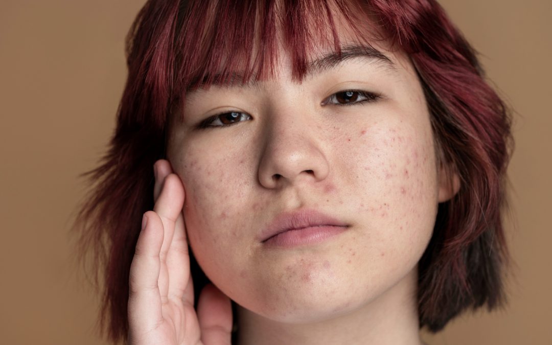 Evaluating Microdermabrasion in Toronto for Post-Acne Texture