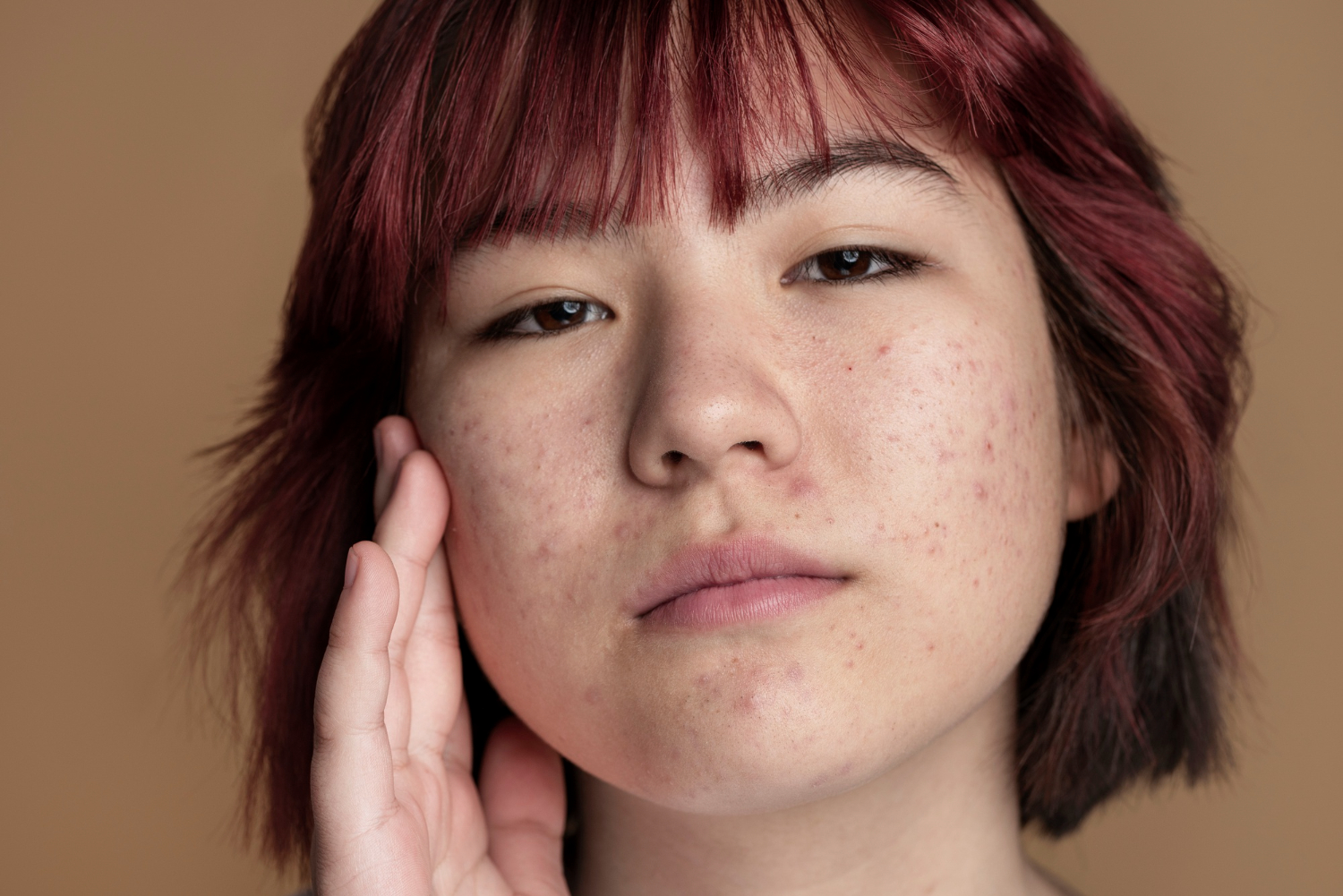 acne scars in face acne scars in face