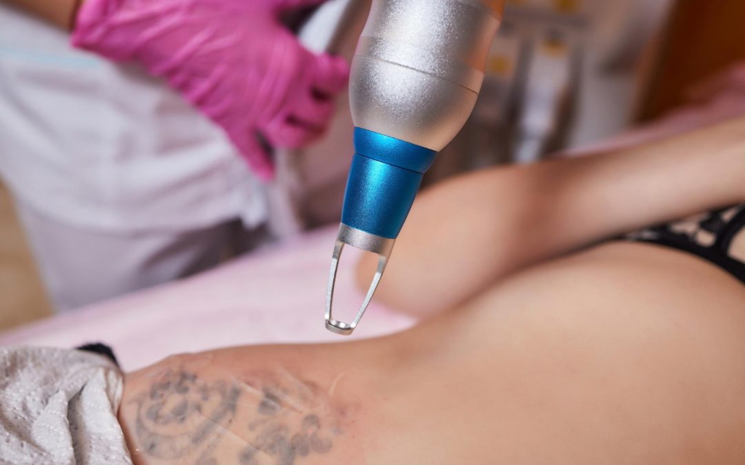 Inside PicoSure in Toronto for Acne Scars and Tattoo Removal