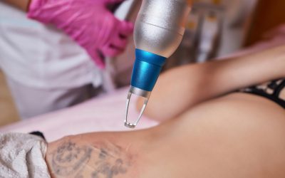 Inside PicoSure in Toronto for Acne Scars and Tattoo Removal