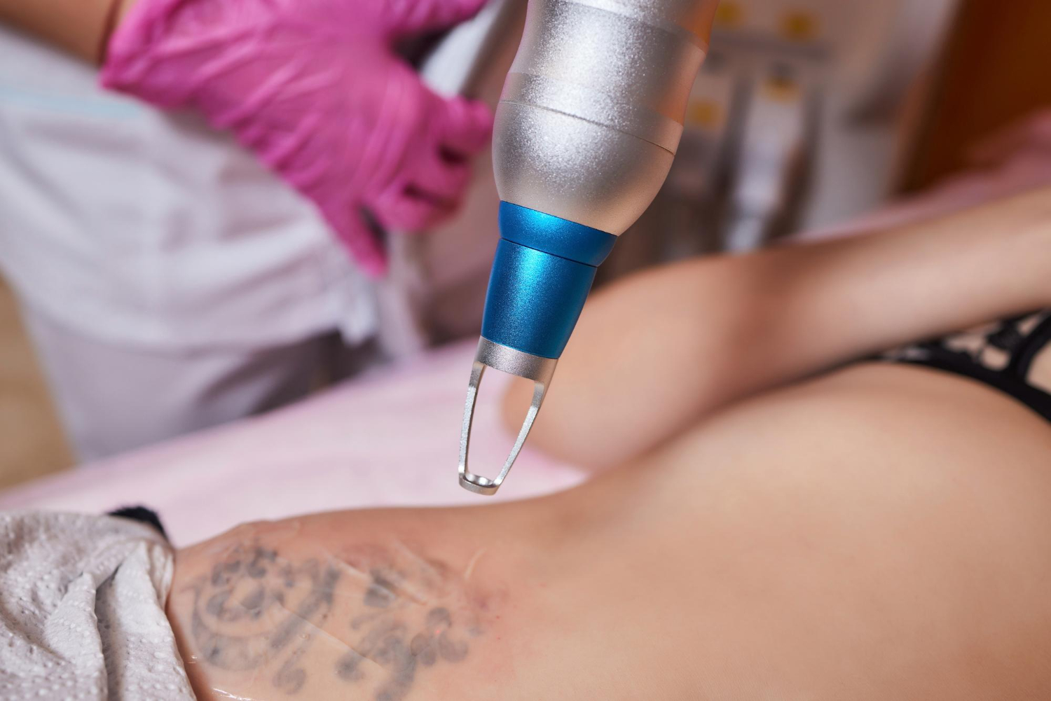tattoo removal tattoo removal